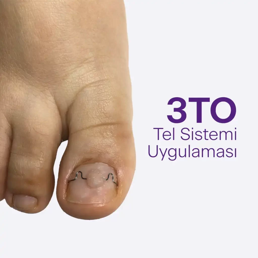 Batık Tırnak'ta 3TO Tel Sistemi Uygulaması