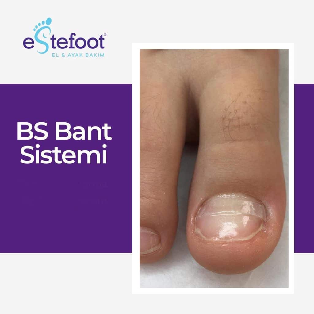 Batık Tırnak BS Bant Sistemi Uygulamasının Etkileri