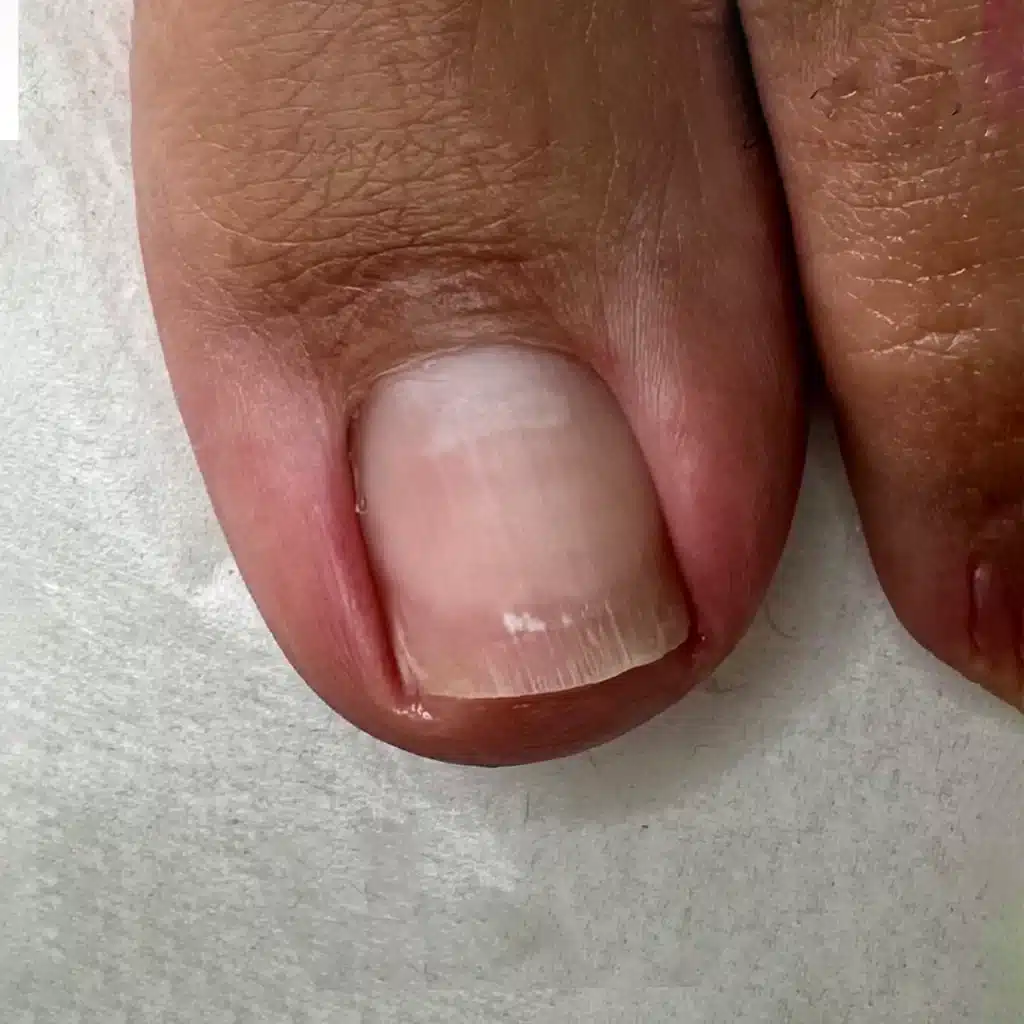 Batık tırnak, tırnağın kenarının yumuşak dokuya doğru büyümesi sonucu oluşan ve genellikle ağrıya, kızarıklığa ve şişliğe neden olan bir durumdur. Bu rahatsızlık en sık ayak başparmağında görülür ve tedavi edilmezse enfeksiyon gibi daha ciddi sorunlara yol açabilir.