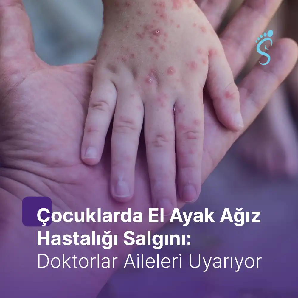 Çocuklarda El Ayak Ağız Hastalığı Salgını: Doktorlar Aileleri Uyarıyor