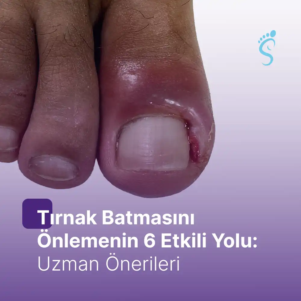 Tırnak Batmasını Önlemenin 6 Etkili Yolu: Uzman Önerileri