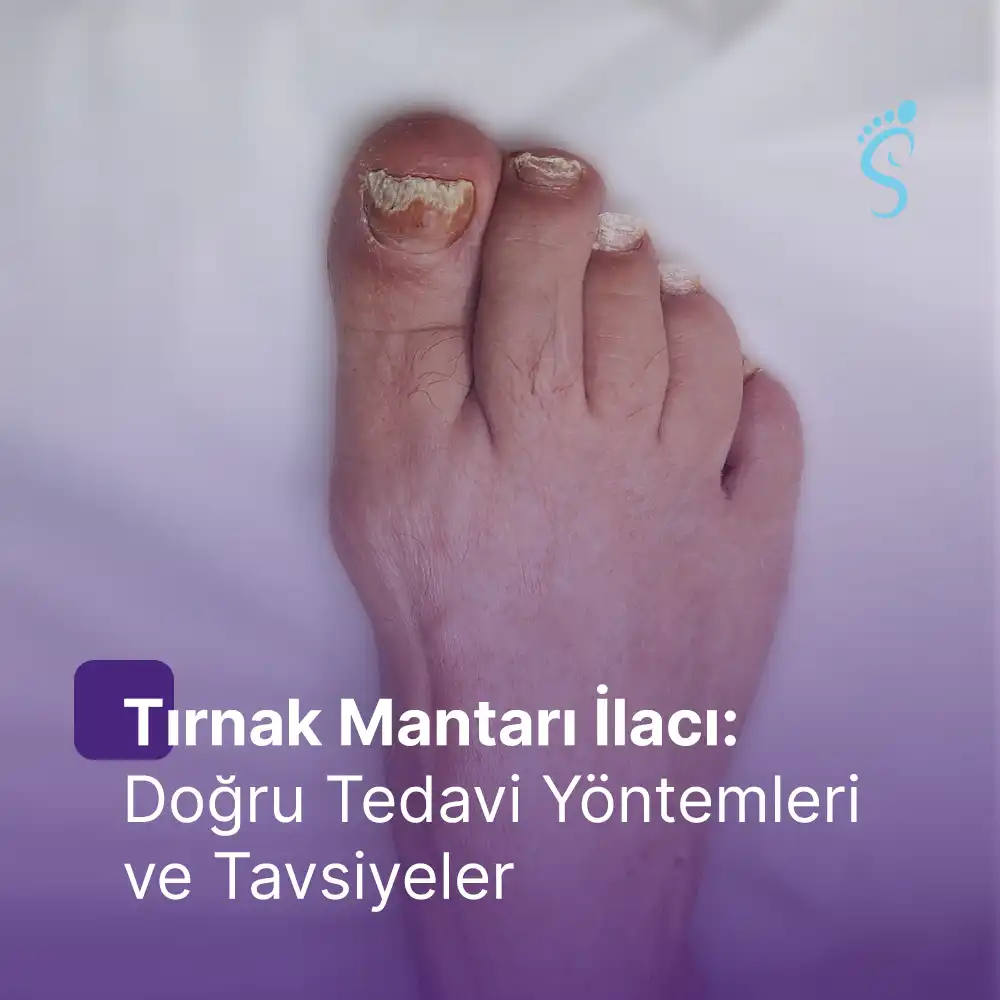 Tırnak Mantarı İlacı: Doğru Tedavi Yöntemleri ve Tavsiyeler
