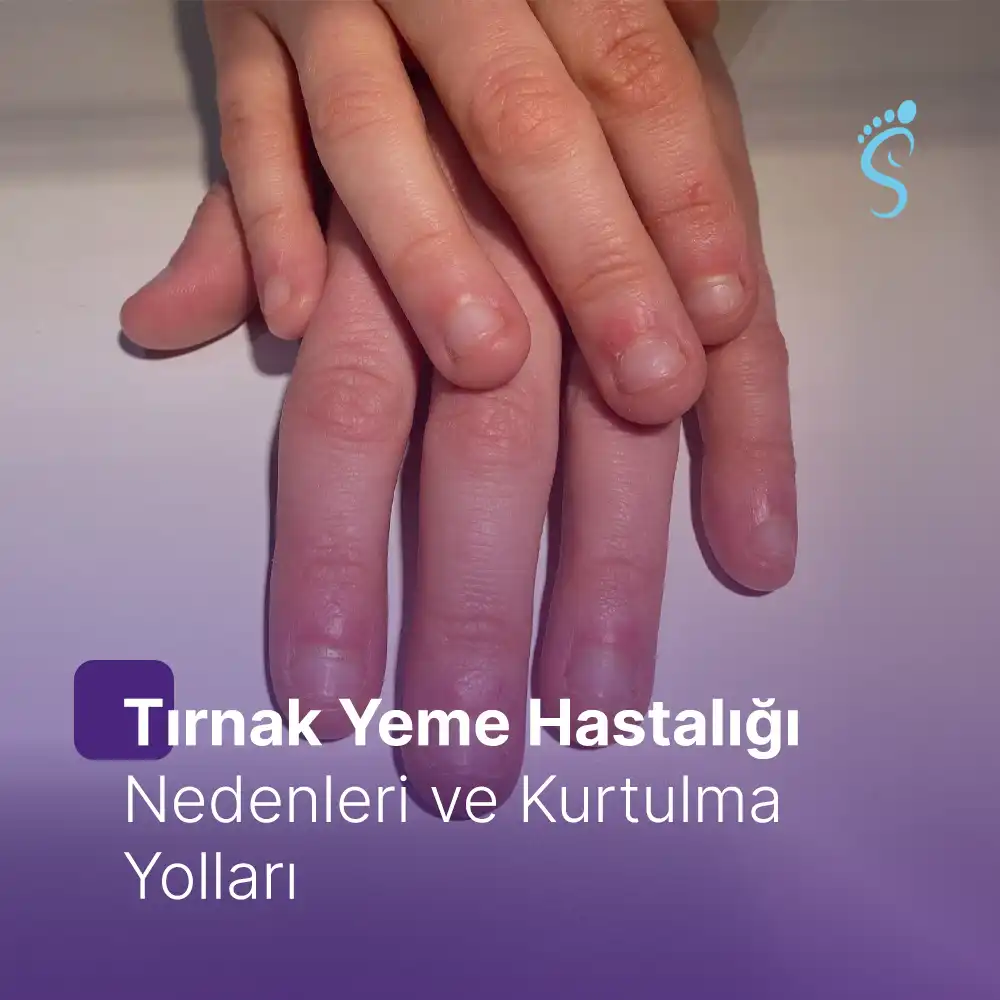 Tırnak Yeme Hastalığı (Onikofaji): Nedenleri ve Kurtulma Yolları